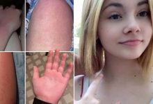 Фото - Девочка-подросток с ужасом выяснила, что у неё аллергия на воду