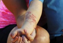 Фото - Маленький турист пострадал от аллергии на татуировку хной