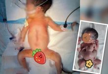 Фото - Младенец появился на свет с близнецом-паразитом, у которого были только руки и ноги