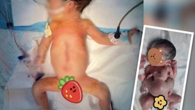 Фото - Младенец появился на свет с близнецом-паразитом, у которого были только руки и ноги