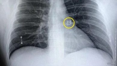 Фото - Мужчина, потерявший серьгу из носа, нашёл её пять лет спустя в собственном лёгком